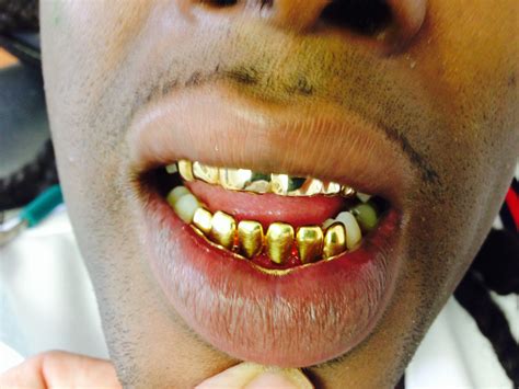 permanent gold teeth  florida teethwalls