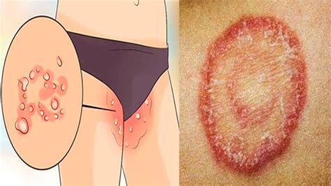 treat private part itching fungal infection burning yeast infection youtube