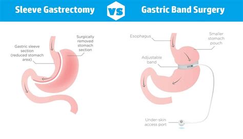 Gastric Sleeve Or Lap Band Surgery What Is Best For You