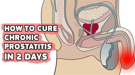 how to cure chronic prostatitis youtube