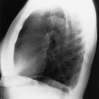 abb  postoperative roe thoraxaufnahmen nach  monaten  roe thorax