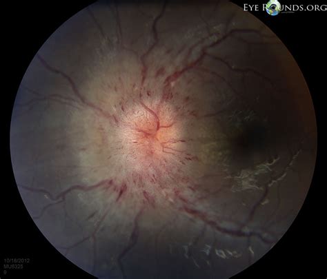 Online Atlas Of Ophthalmology The University Of Iowa