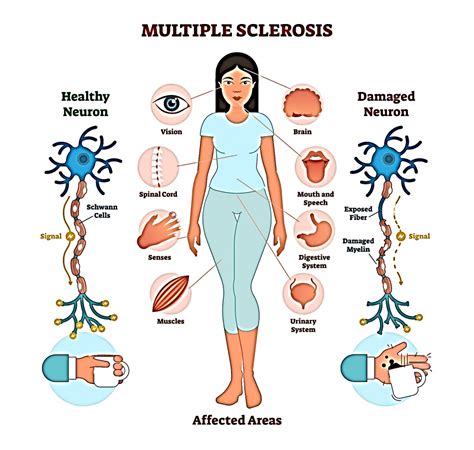 multiple sclerosis nursing tutorials