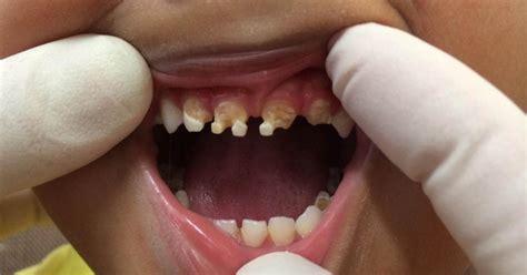 Like Pepsi Or Coca Cola Dentist Reveals Images That Will Put You Off