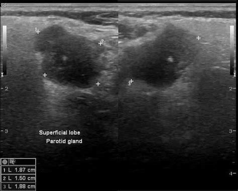 adenom der speicheldruese ursachen symptome und behandlungsmethoden