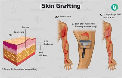 skin grafting procedure purpose results cost price