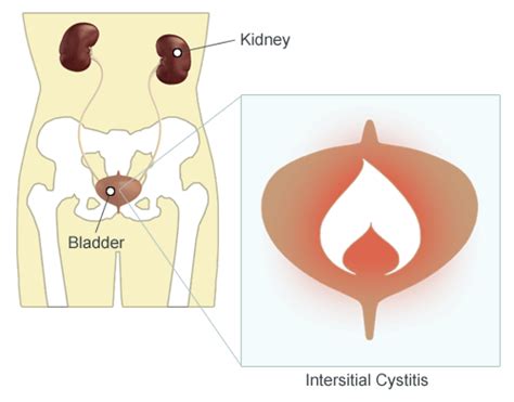 female overactive bladder caused by interstitial cystitis