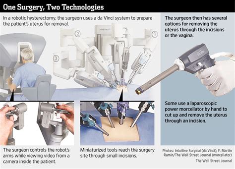 How Surgical Robots Spurred Morcellator Use In Hysterectomies Wsj