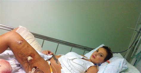 Miss Bumbum Contestant Reveals Damage From Botched Surgery