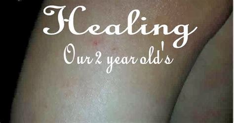 it s a mom life healing a 2 year old s eczema