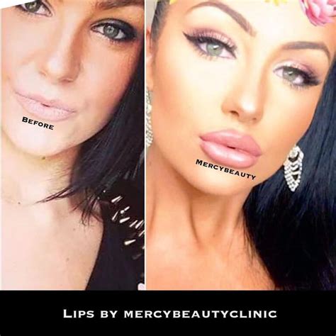 image result  keyhole lip injections    pictures
