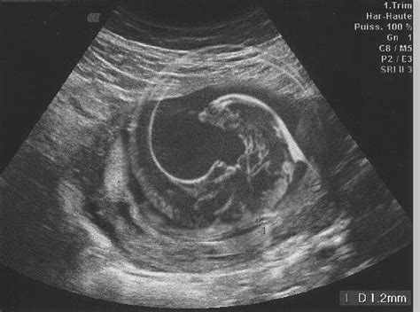 12 Week Ultrasound Guess — The Bump