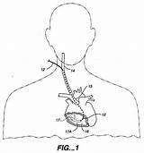 Sinus Coronary Patentler Resimler Catheter sketch template