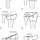 Radius Dorsal Distal Angulation Fractures Radiographic Colles Outcome sketch template