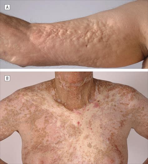 call   dermatologic input  chronic graft  host disease clinical trials allergy