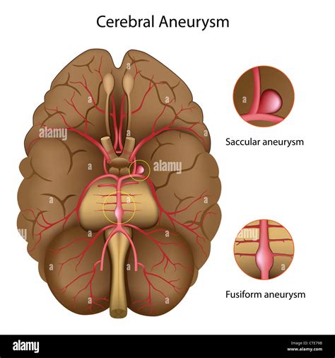 lista  foto ramas de la arteria cerebral media el ultimo