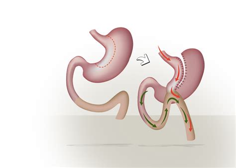 Mini Gastric Bypass Lose Weight With Affordable Care In