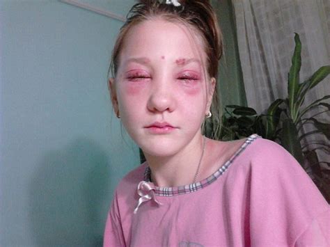 Russian Teen Left Partially Blind And Suffering Chemical Burns After £3