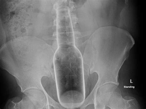 hilarious x ray findings that seem too crazy to be real obsev