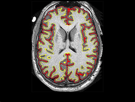 study finds multiple sclerosis drug slows brain shrinkage thirdage