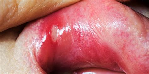 home remedies  canker sores mens health