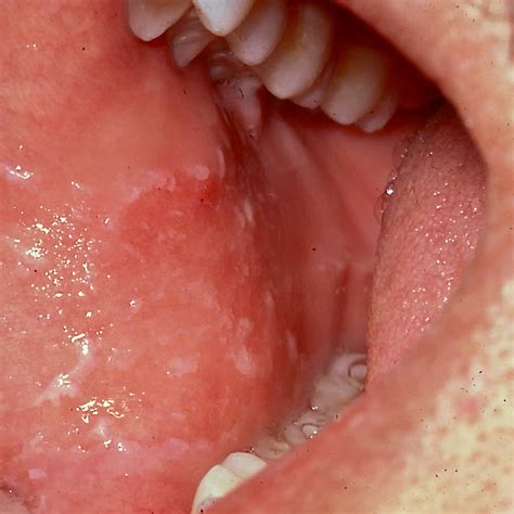 benign chronic white lesions   oral mucosa article