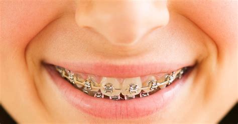 adult braces indicate high self esteem huffpost uk