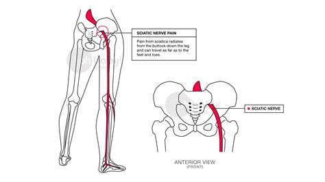 sciatic nerve days  fitness