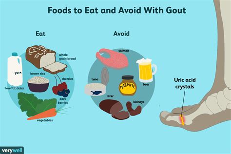 Food For Gout What To Eat And Avoid On A Gout Diet