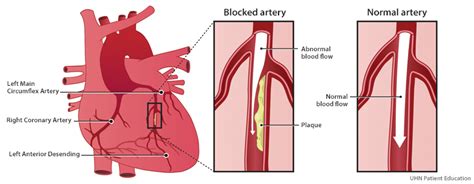 angina cardiac college
