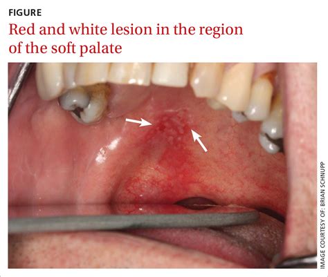 oral cancer soft palate