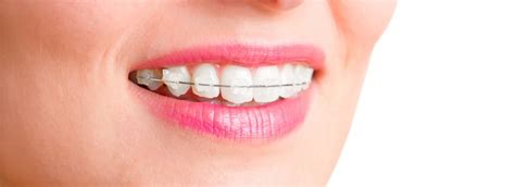 Dental Braces Cost For Adults In London Uk From £1 099