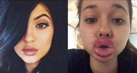 the kylie jenner lip challenge has turned into a complete disaster 19