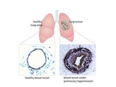 Lung Cancer Triggers Pulmonary Hypertension