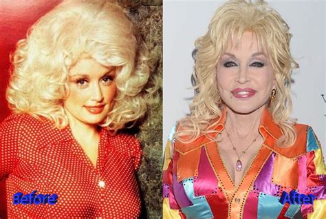 dolly parton plastic surgery gracefully getting old or not plastic surgery mistakes