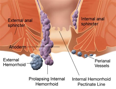 piles symptoms causes and treatments