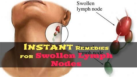 How To Get Rid Of Swollen Lymph Nodes Naturally 5 Remedies For
