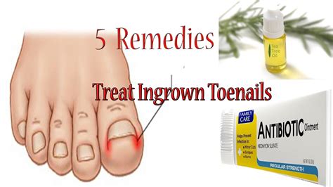 remedies  treat ingrown toenails  home youtube