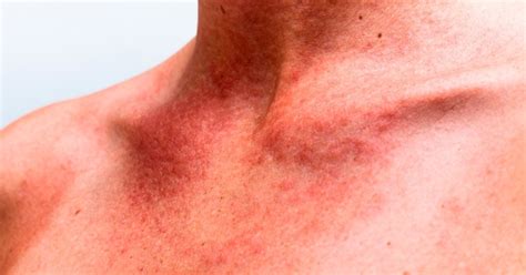 alergia na pele como identificar causas  como tratar tua saude
