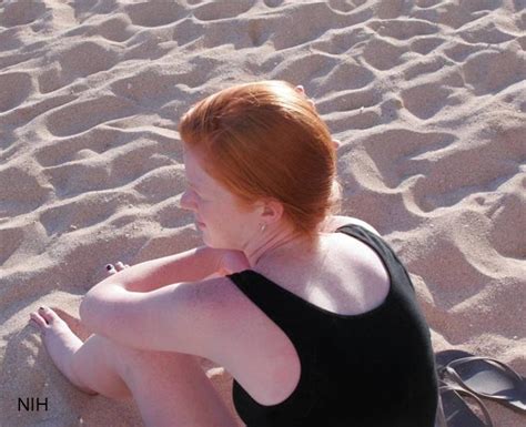 why redheads are more susceptible to melanoma nih director s blog