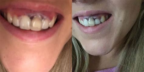 woman shares photos of bad teeth whitening job that burned