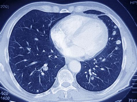 medicare poised  cover ct scans  screen  lung cancer shots