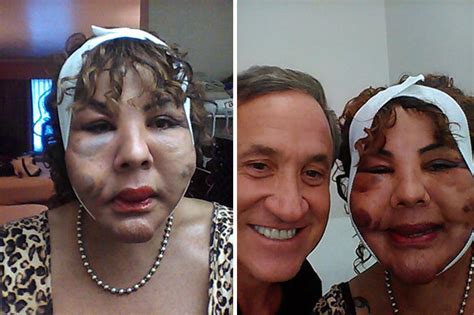 Transgender Woman Who Had Cement Injections Begs Botched Surgeons To