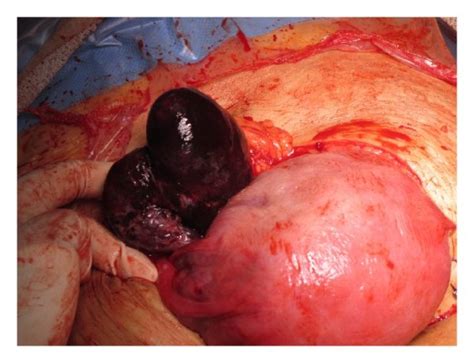 a right ovarian cyst torsion b right ovary following resection of