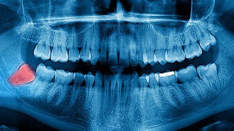 impacted wisdom tooth symptoms  treatment modern day smiles
