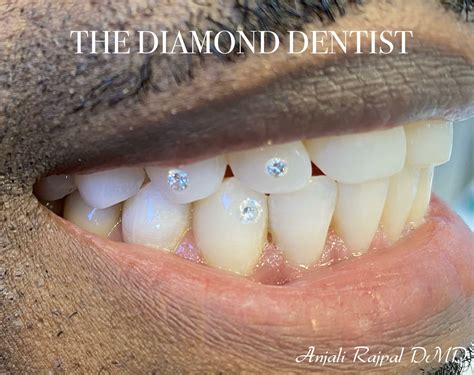 diamonds dental implants