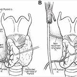Laryngeal Nerve Recurrent Thyroid Surgery Variations Rln Nerves Randolph Outcomes Guideline Improving Saunders Elsevier Permission Reprinted Parathyroid Glands Gland Sln sketch template