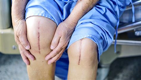 1 Knee Replacement Surgery Sets The Stage For Another