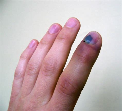 smashed finger       smashed finger