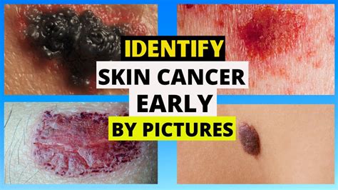 early stage skin cancer  leg